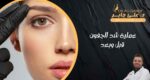عملية شد الجفون قبل وبعد