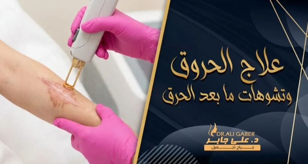Laser treatment for old burn scars to remove pigmentation.