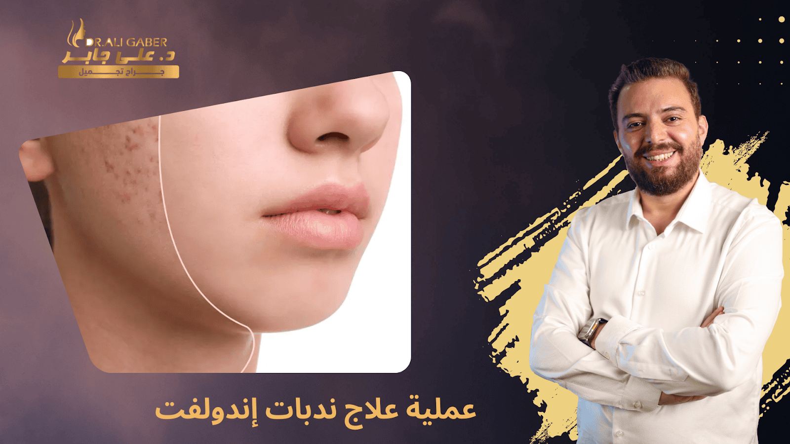 ندبات إندولفت