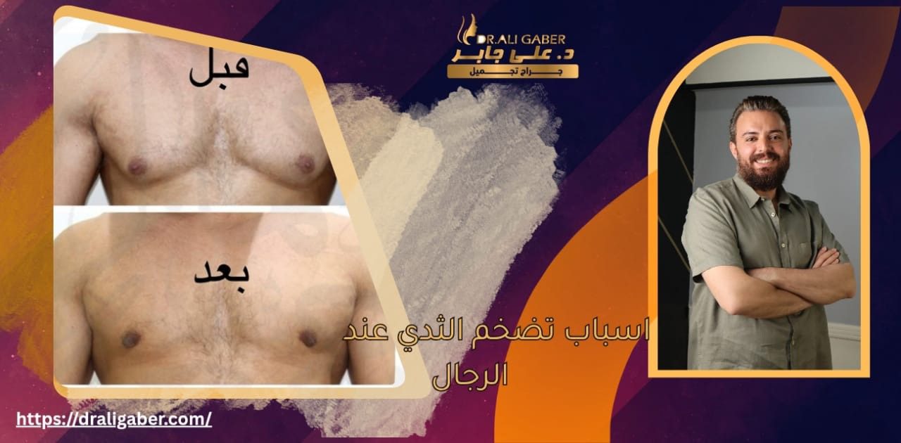 تضخم الثدي عند الرجال