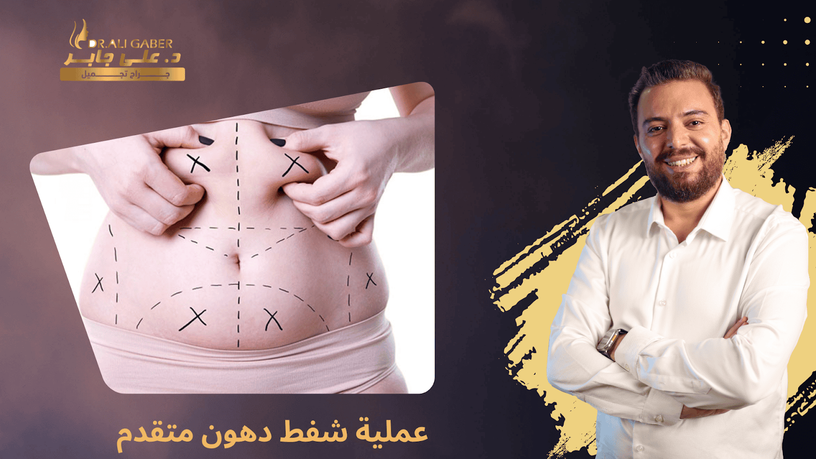 عمليه شفط دهون