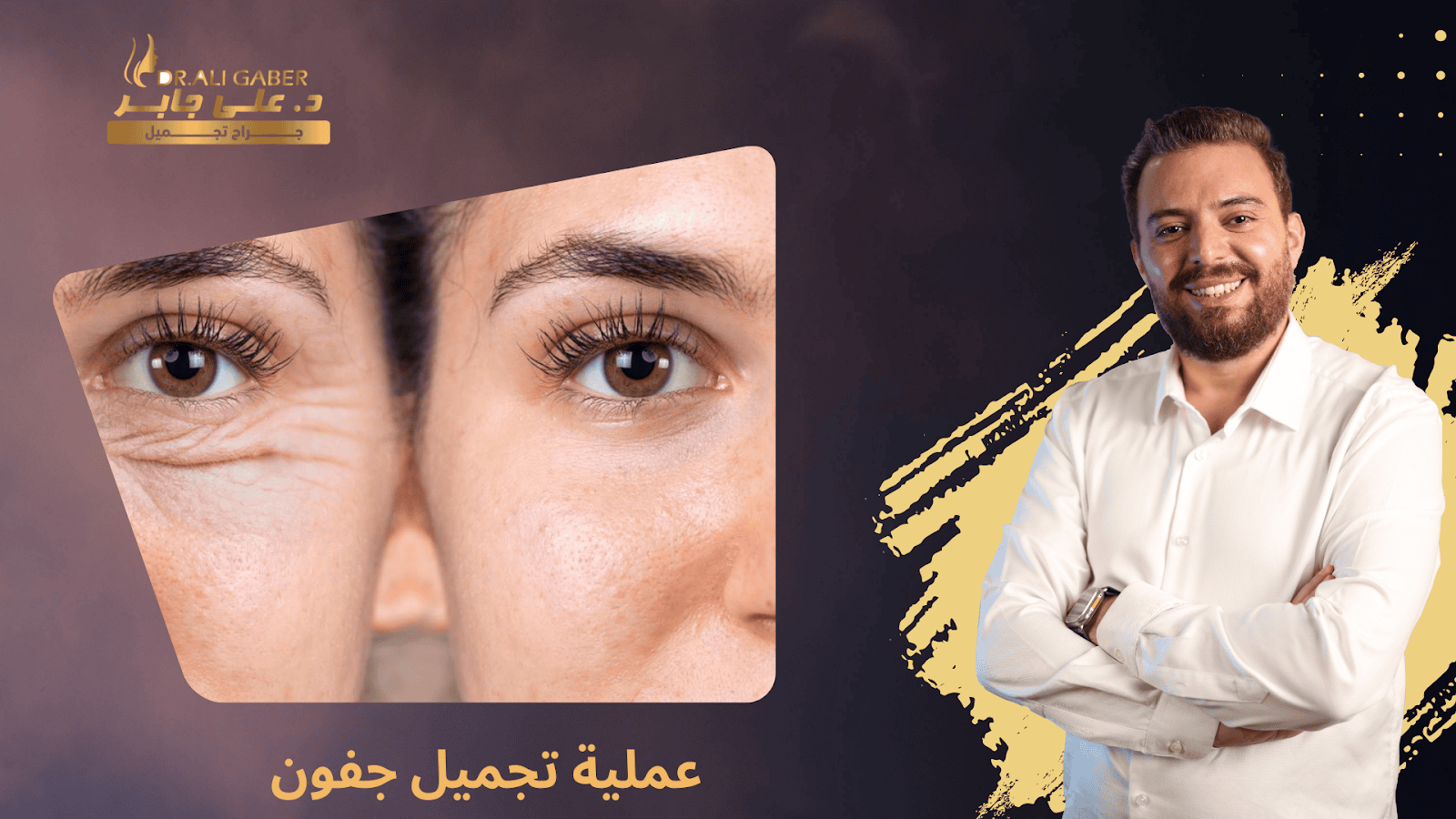 تجميل جفون
