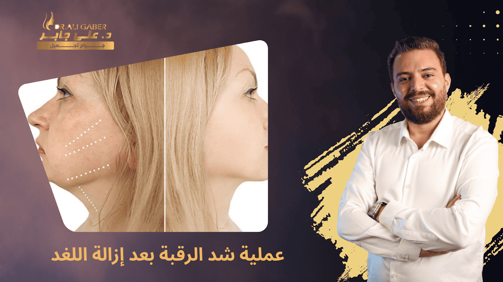 شد الرقبة مع إزالة اللغد