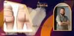 عملية شد المؤخرة