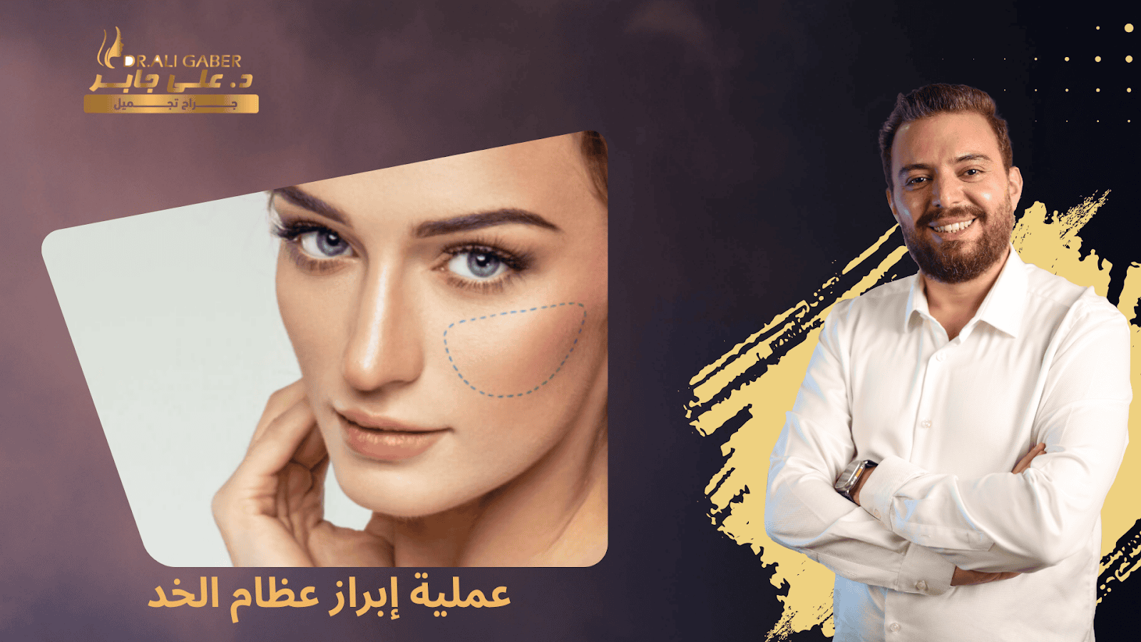 عملية إبراز عظام الخد