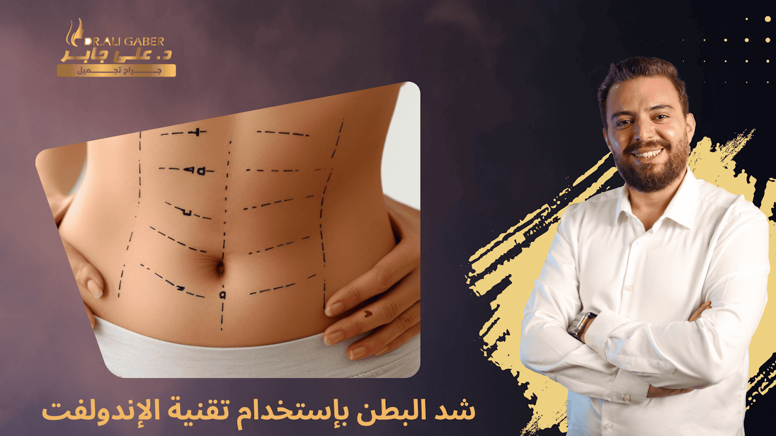 شد البطن بإستخدام تقنية الإندولفت