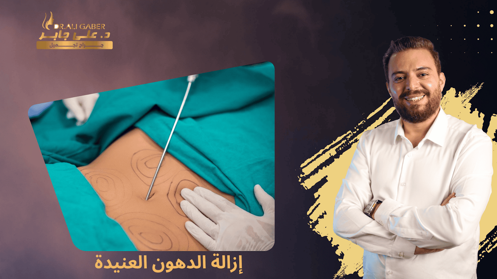 إزالة الدهون العنيدة