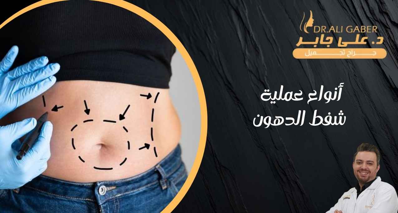 عملية شفط الدهون
