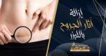 ازالة آثار الجروح بالليزر