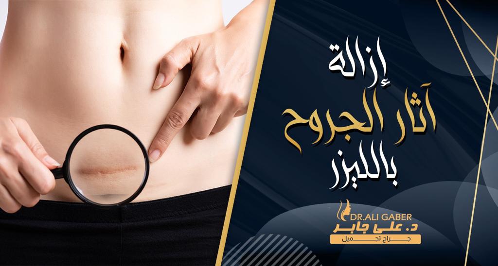 ازالة آثار الجروح بالليزر