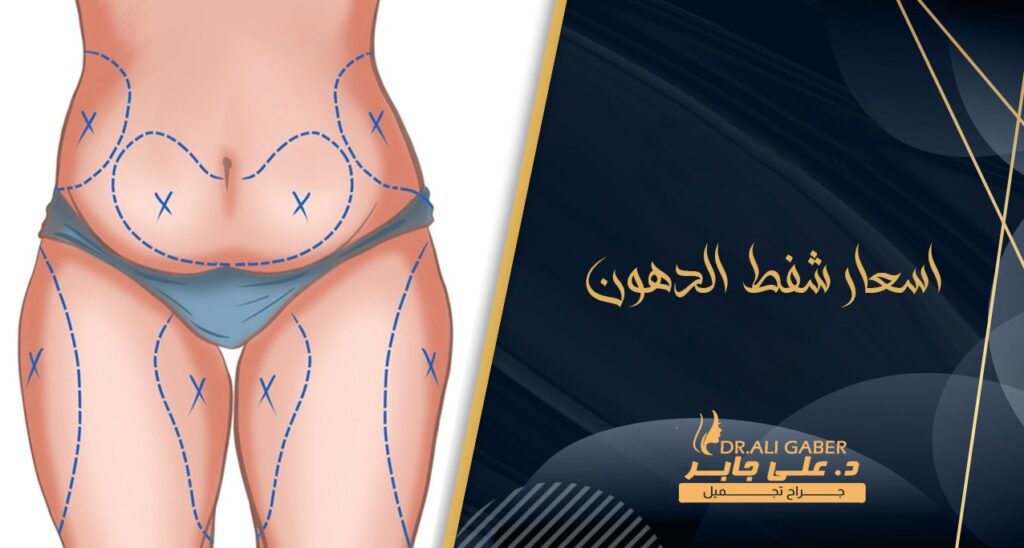 اسعار عمليات شفط الدهون