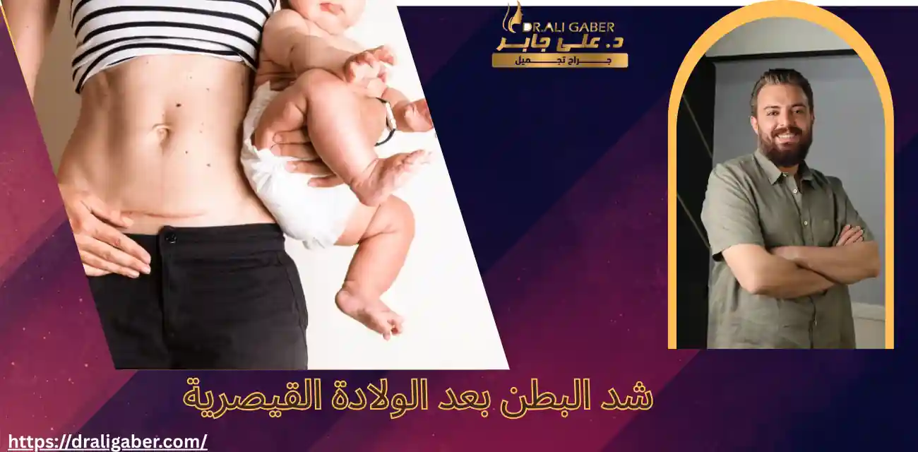 شد البطن بعد الولادة القيصرية