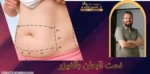 نحت البطن بالفيزر