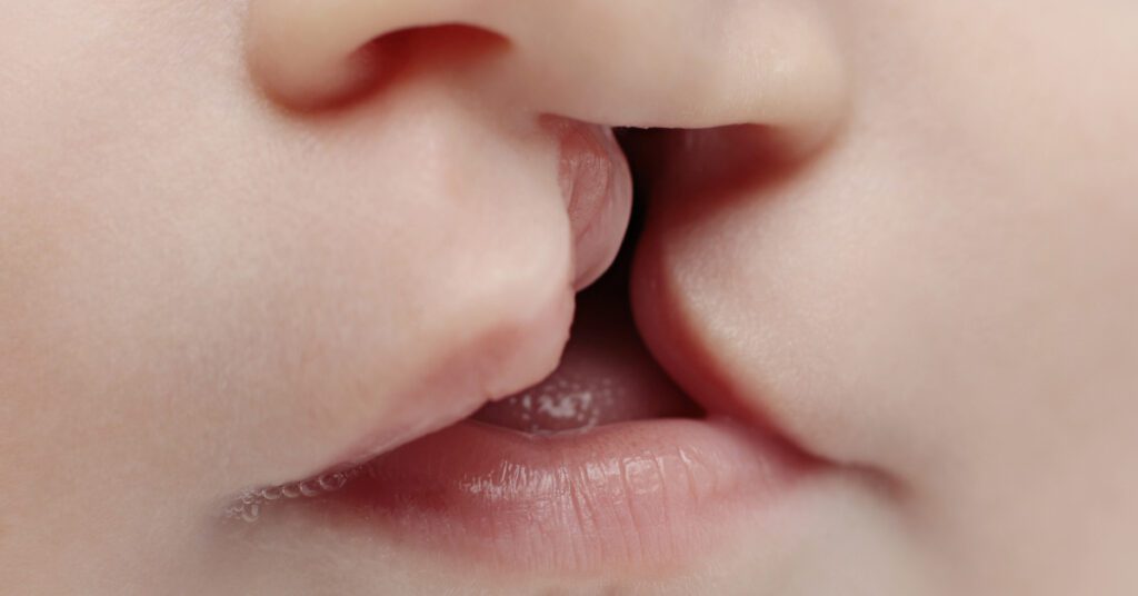 الشفة الأرنبية