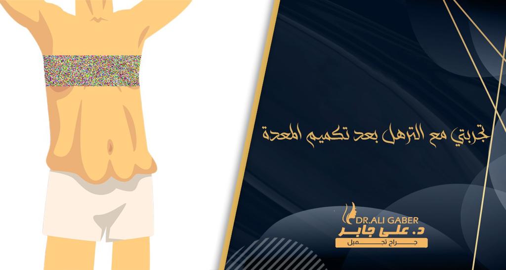 تجربتي مع الترهل بعد تكميم المعدة