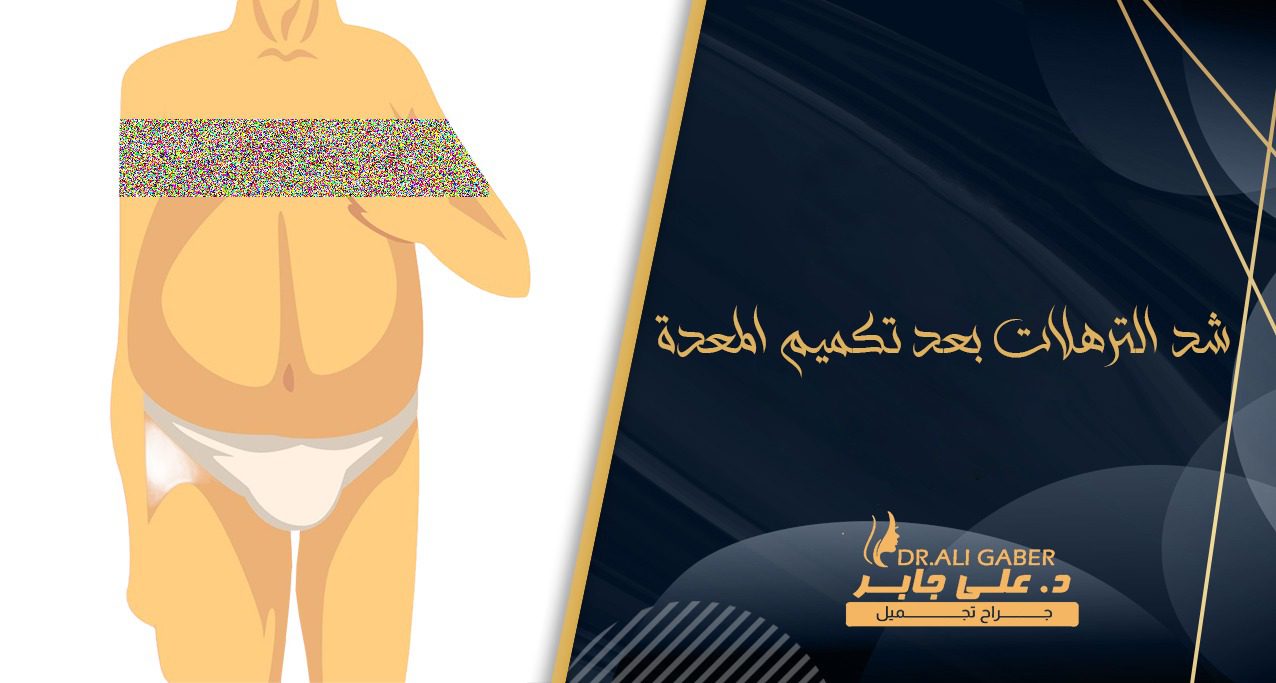 شد الترهلات بعد تكميم المعدة