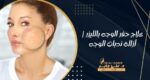علاج حفر الوجه بالليزر أزالة ندبات الوجه