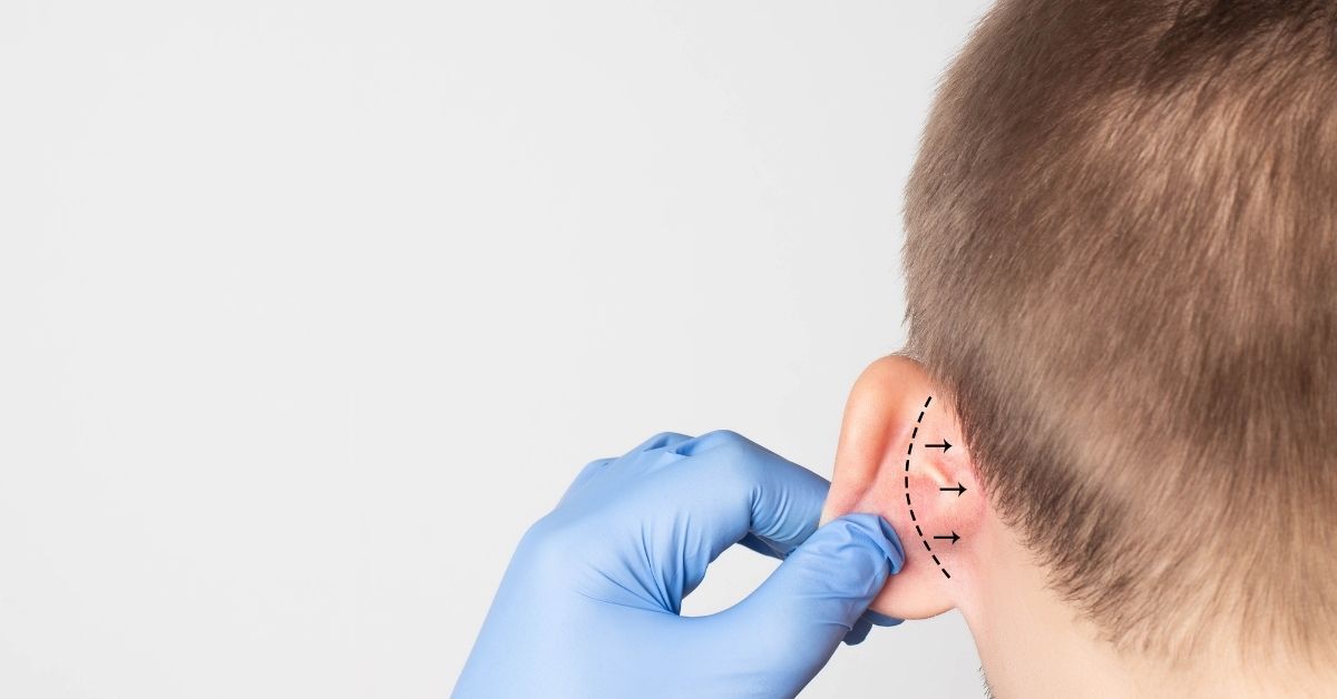 عملية تجميل الأذن الخفاشية