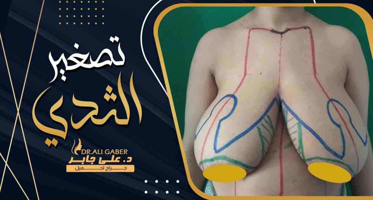 عملية تصغير الثدي
