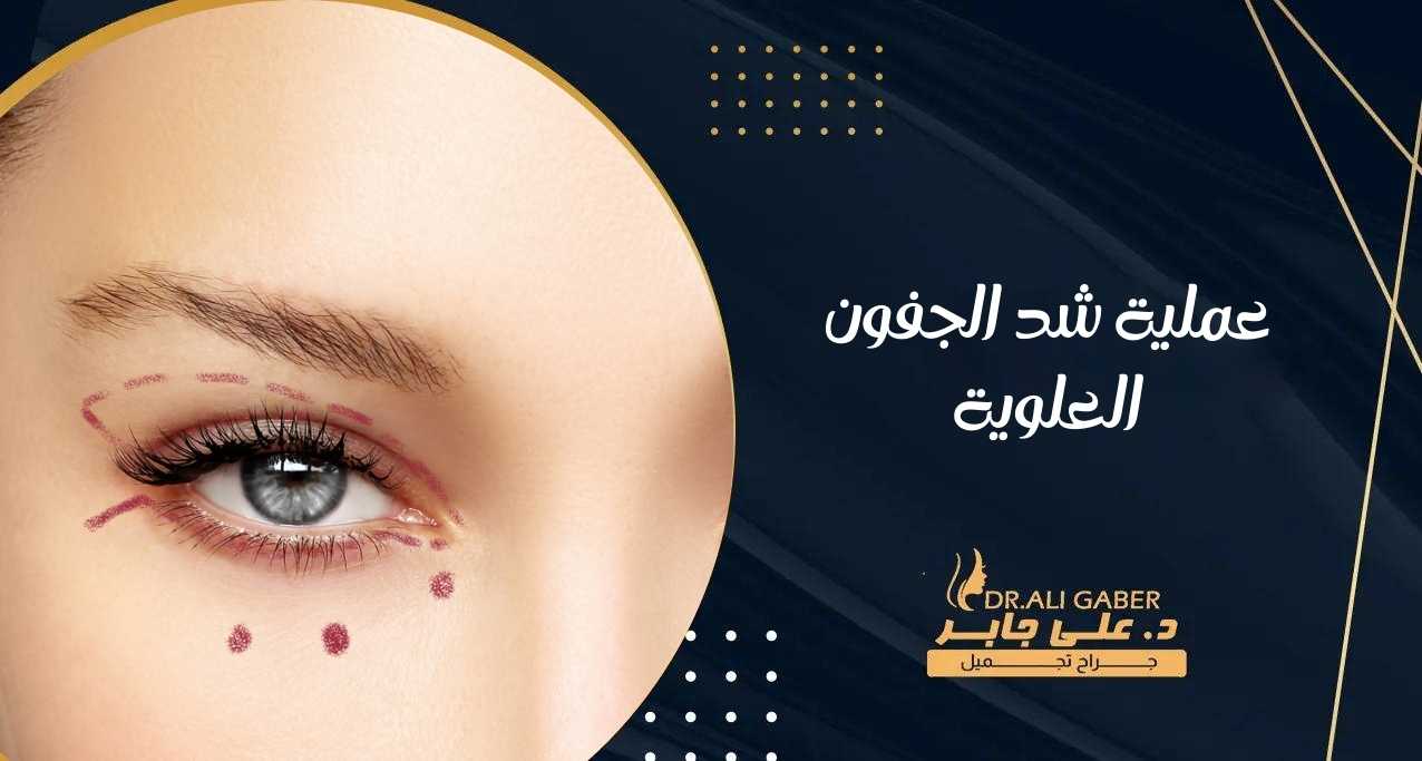 عملية شد الجفون العلوية