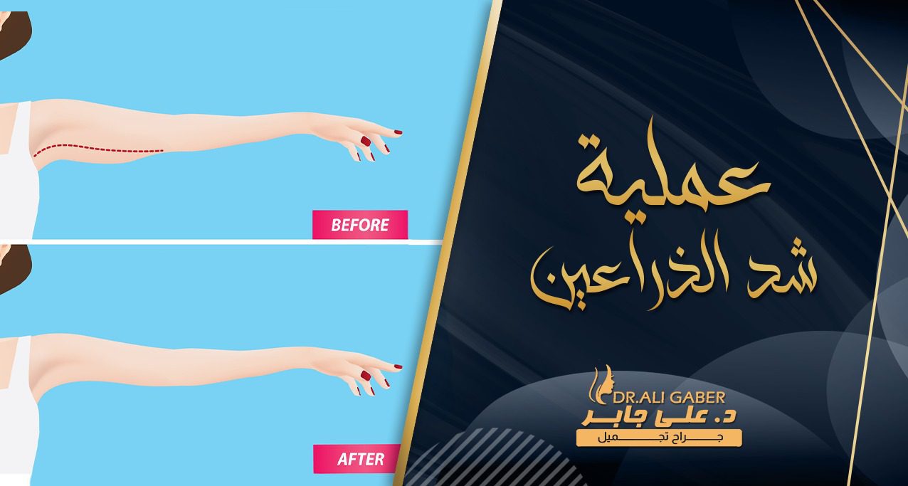 عملية شد الذراعين