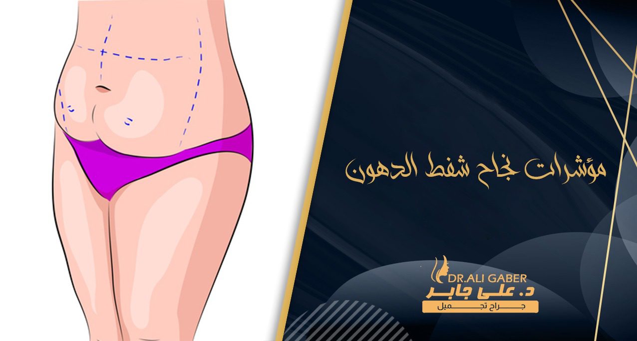 نجاح عملية شفط الدهون