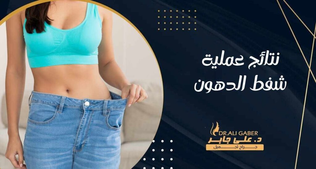 نتائج عملية شفط الدهون