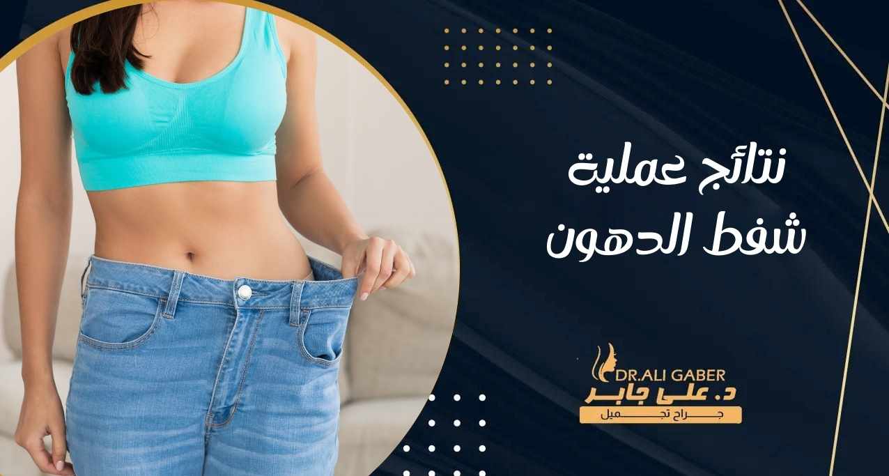 نتائج عملية شفط الدهون