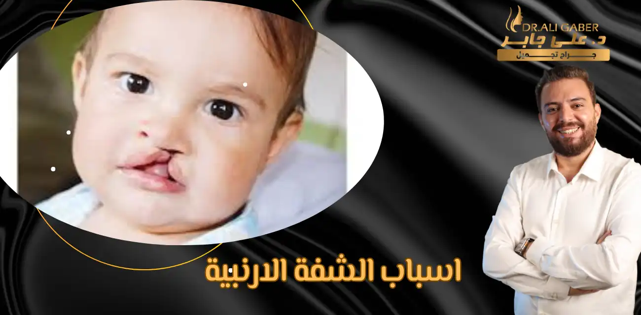 اسباب الشفة الارنبية