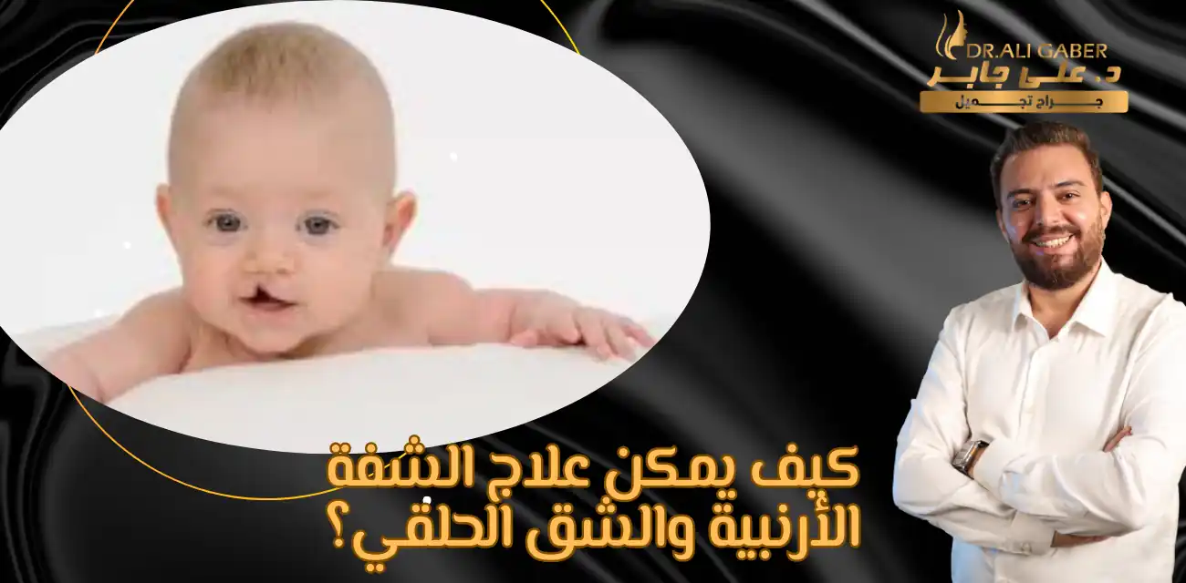 اسباب الشفة الارنبية
