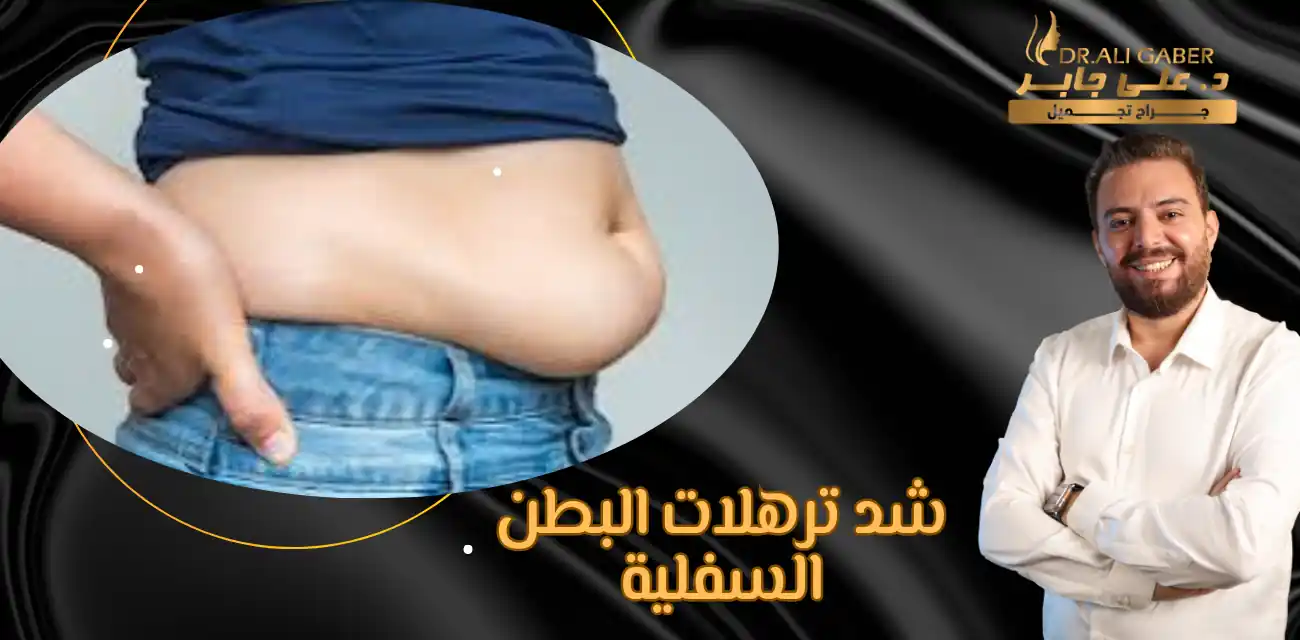 شد ترهلات البطن السفلية