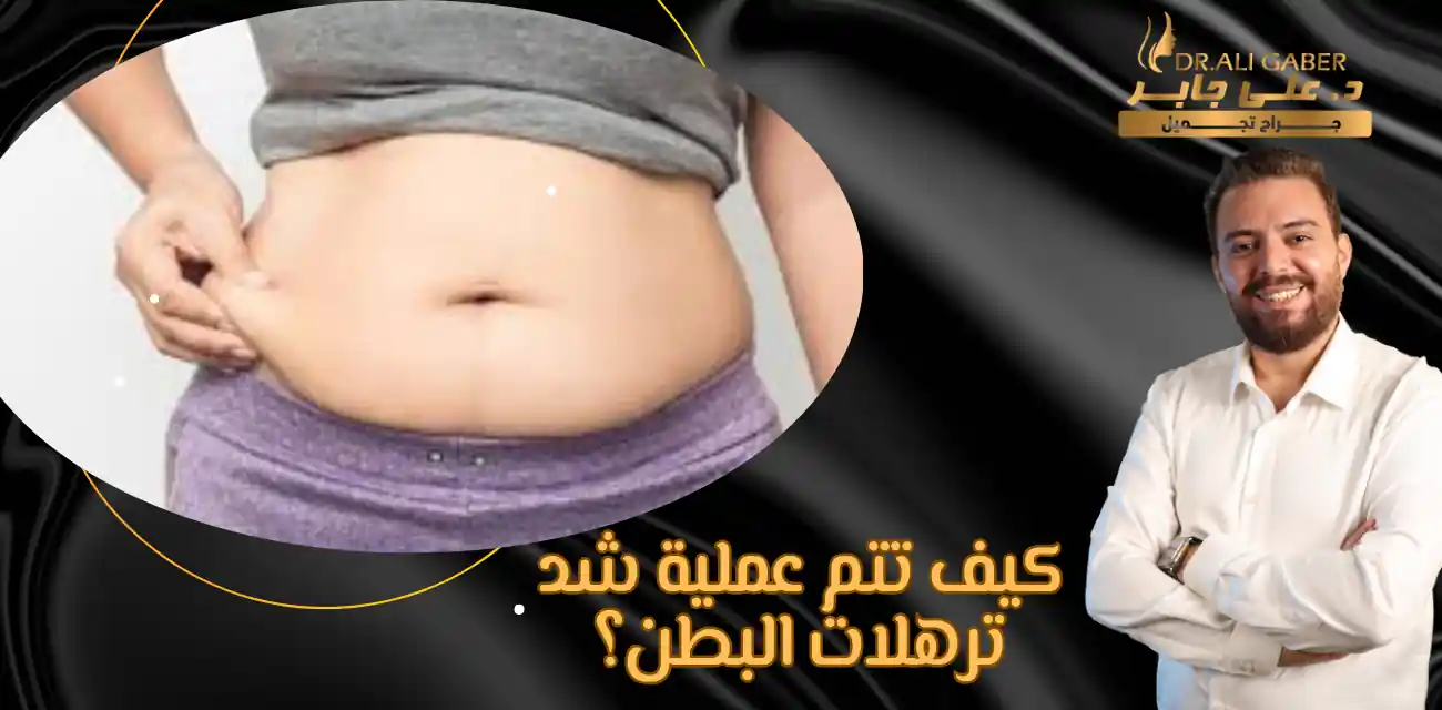 شد ترهلات البطن السفلية