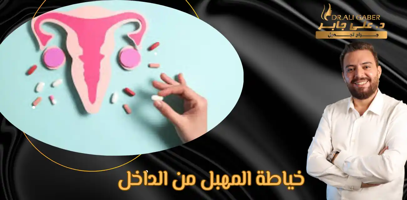 خياطة المهبل من الداخل