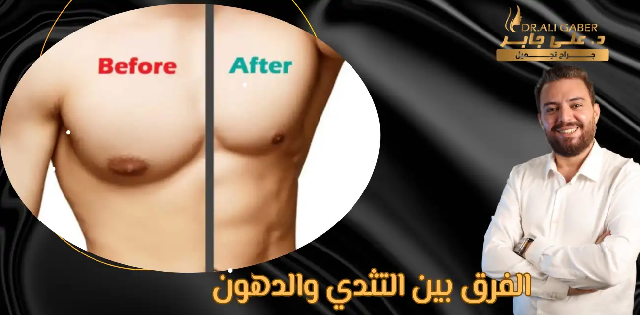 الفرق بين التثدي والدهون
